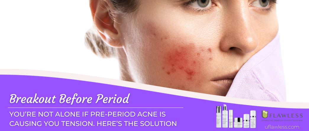Breakout Before Your Period? You Are Not Alone on Pre-period Acne