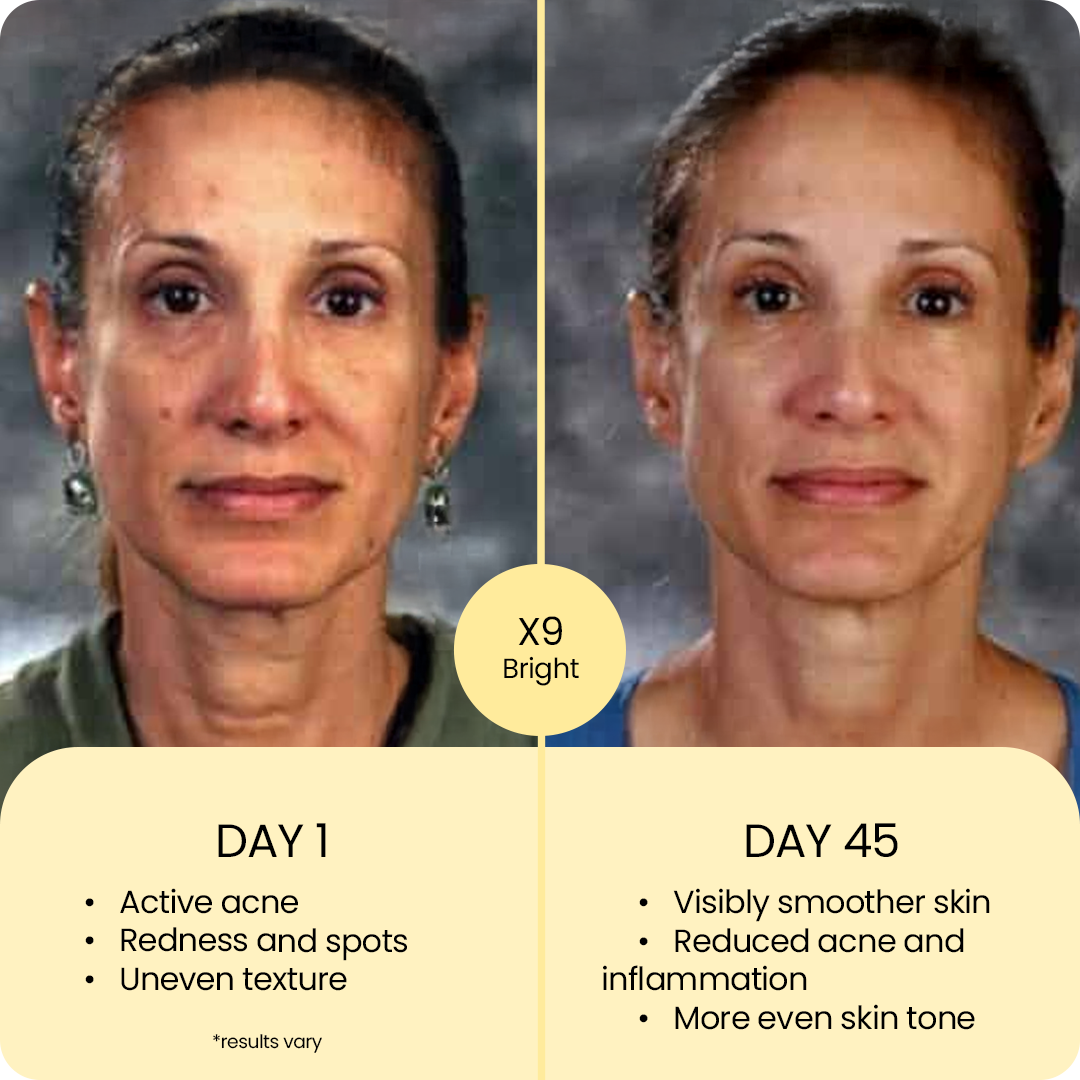 X9 Advanced Brightening Routine | Hydroquinone-Free