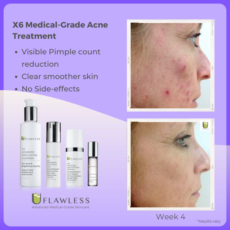 X6 Acne Routine | Advanced Acne Treatment | Natural Ingredients