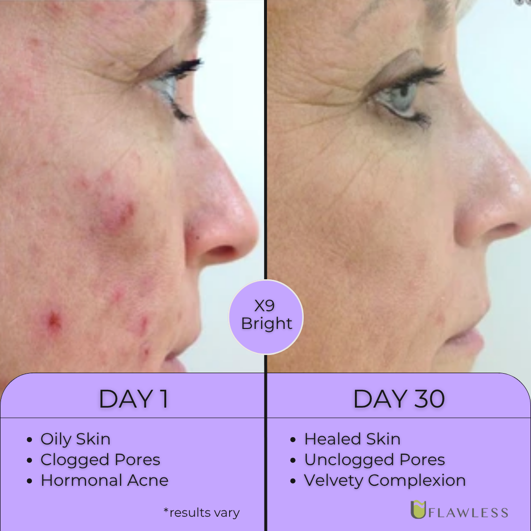 X6 Acne Routine | Advanced Acne Treatment | Natural Ingredients