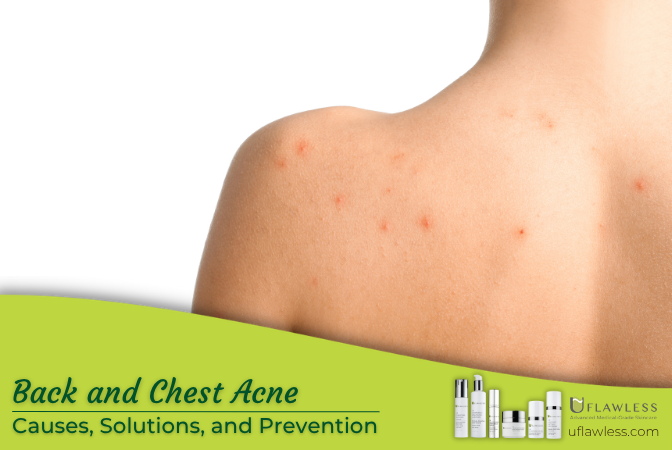 Back and Chest Acne: Causes, Solutions and Prevention