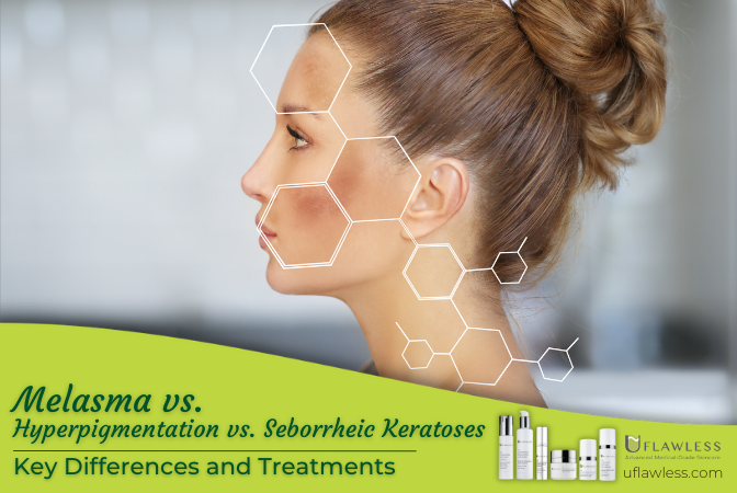 Melasma vs. Hyperpigmentation vs. Seborrheic Keratoses: Key Differences and Treatments