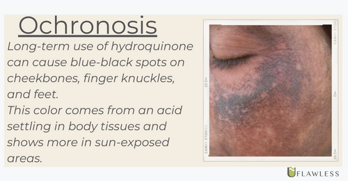Ochronosis is one of the side effects of hydroquinone
