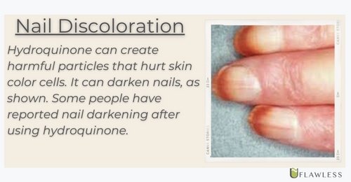 One of the side effects of hydroquinone is nail discoloration.