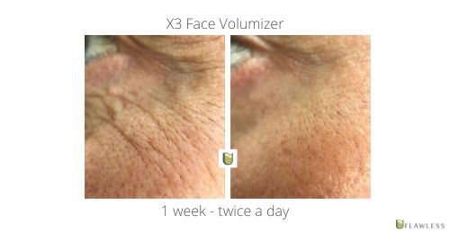 X3 Face Volumizer 1 week II