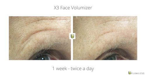 X3 Face Volumizer 1 week