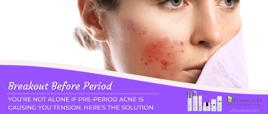 Breakout before period? You're not alone on Pre-Period Acne