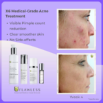 X6 Acne Treatment B&A